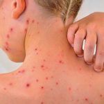 Erupciones cutáneas comunes en la niñez